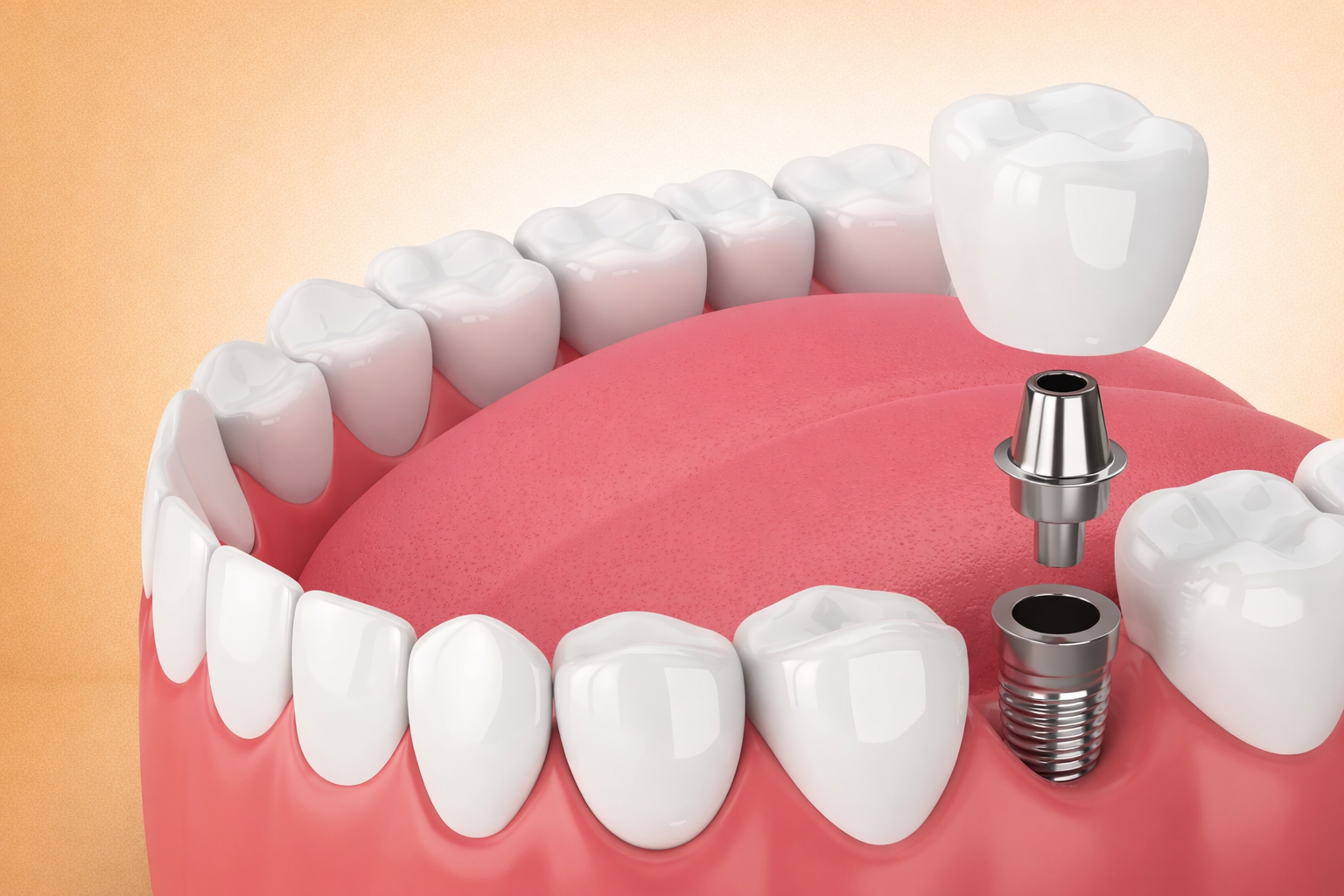 Dental implant installation process close-up
