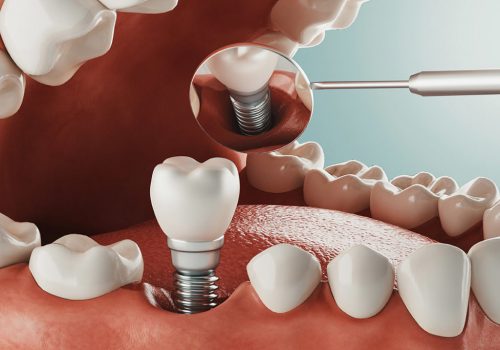 dental-implants-voss-1170x684